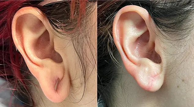 Best Ear Lobe Repair Treatment in Gurgaon, Delhi