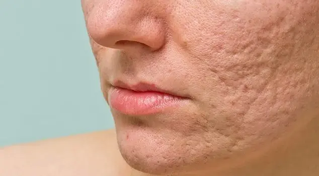 Acne Scar Treatment in Gurgaon/Delhi