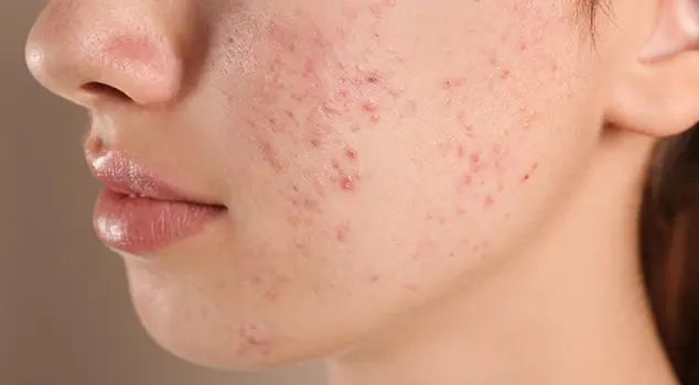 Best Acne Treatment in Gurgaon, Delhi