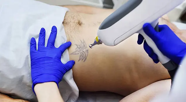 Tattoo Removal Treatment in Gurgaon, Delhi