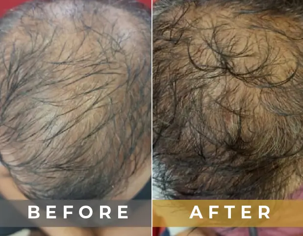 PRP Treatment in Gurgaon, Delhi