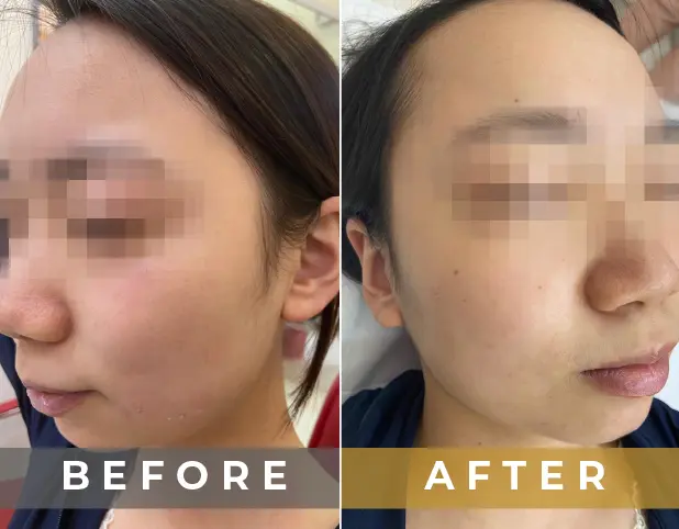 Mole Removal Treatment in Gurgaon, Delhi