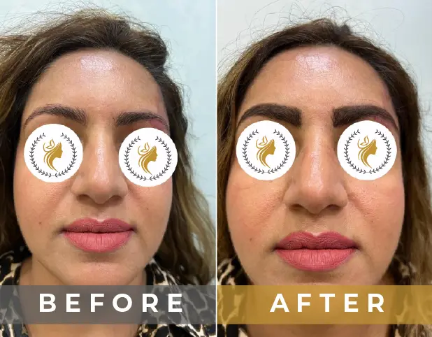 Miroblading Treatment in Gurgaon, Delhi