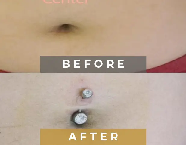 Belly Piercing Treatment in Gurgaon, Delhi