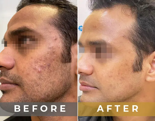 Peel Laser Toning Treatment in Gurgaon, Delhi