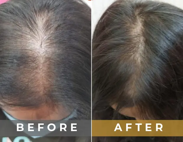 PRP Treatment in Gurgaon, Delhi