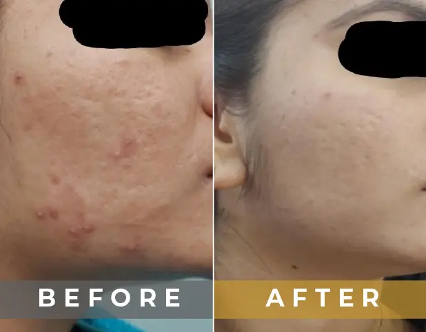 Peels Treatment in Gurgaon, Delhi