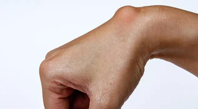 Best Cyst & Lipoma Removal Treatment in Gurgaon, Delhi