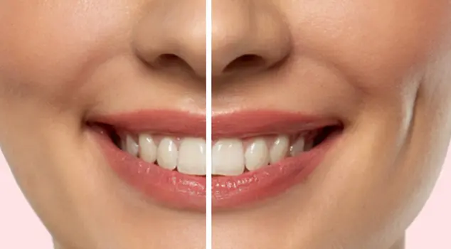 Best Dimple Creation Treatment in Gurgaon, Delhi