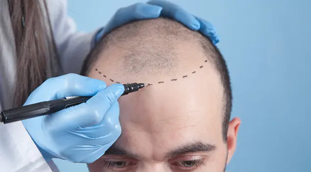 Best Hair Transplant Treatment in Gurgaon, Delhi