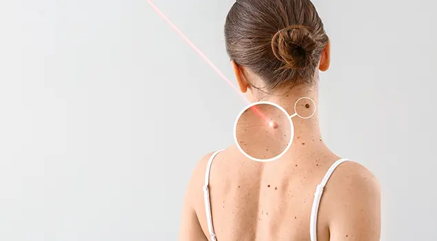 Best Laser Pigmentation Removal Treatment in Gurgaon/Delhi