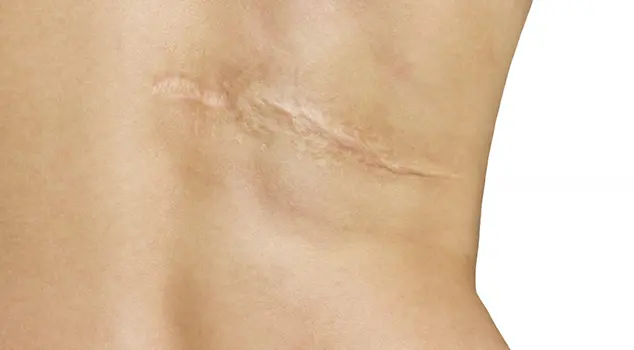 Best Scar Reduction Treatment in Gurgaon, Delhi