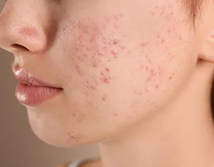 Acne Treatment in Gurgaon, Delhi
