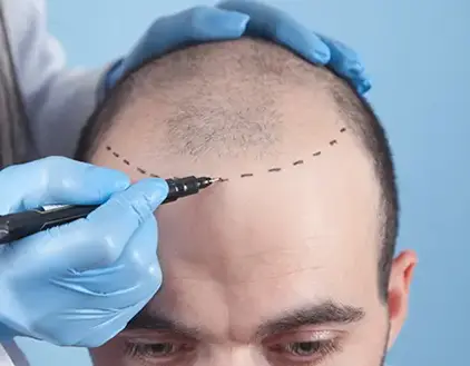 Hair Transplant Treatment in Gurgaon, Delhi