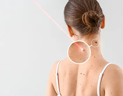 Pigmentation Treatment in Gurgaon