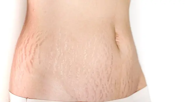 Best Stretch Marks Removal Treatment in Gurgaon, Delhi
